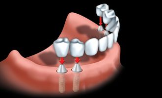 implant 02