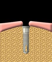implant 1