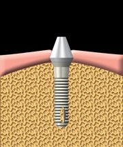 implant 2
