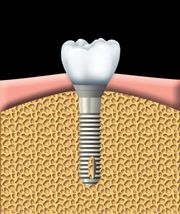 implant 3