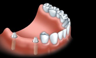 implant 4