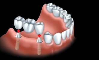 implant 5