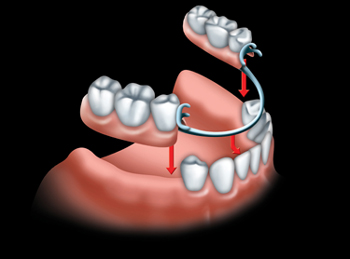 partial denture1