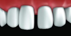 veneers1