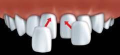 veneers2