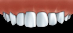 veneers3